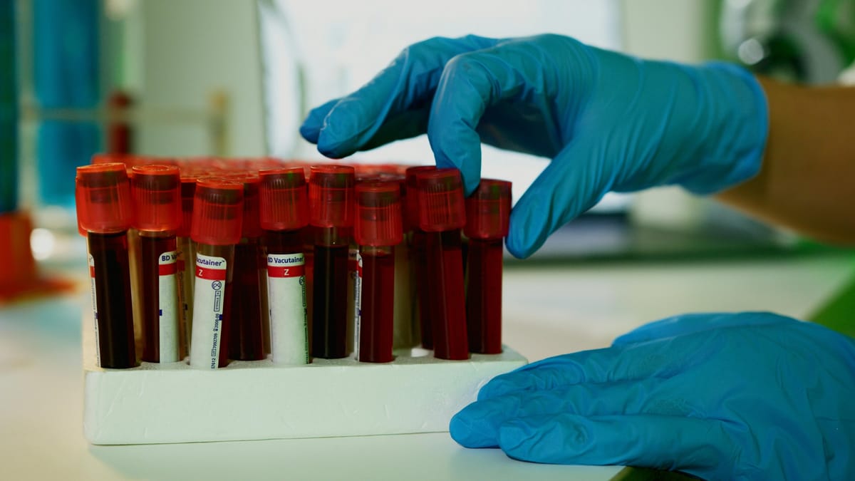 Simple Insulin Resistance Test Signals Faster Cognitive Decline in Alzheimer’s Patients