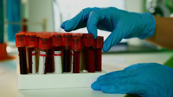 Simple Insulin Resistance Test Signals Faster Cognitive Decline in Alzheimer’s Patients