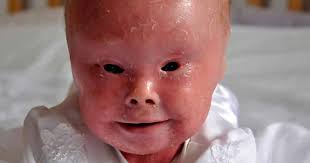 Harlequin Ichthyosis: A Rare Genetic Disease Giving Babies Thick 'Scales'